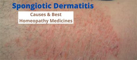 Spongiotic Dermatitis Causes, Symptoms & Treatment