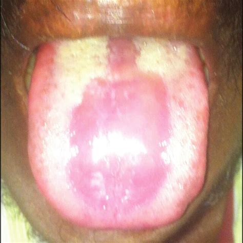 Erythematous candidiasis with a central erythematous, smooth appearance... | Download Scientific ...