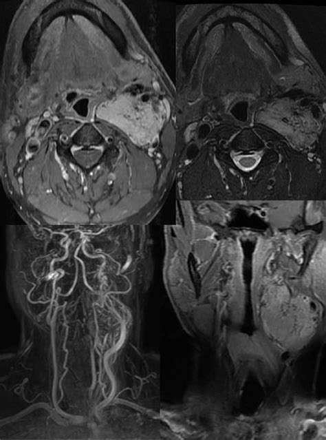 Paraganglioma