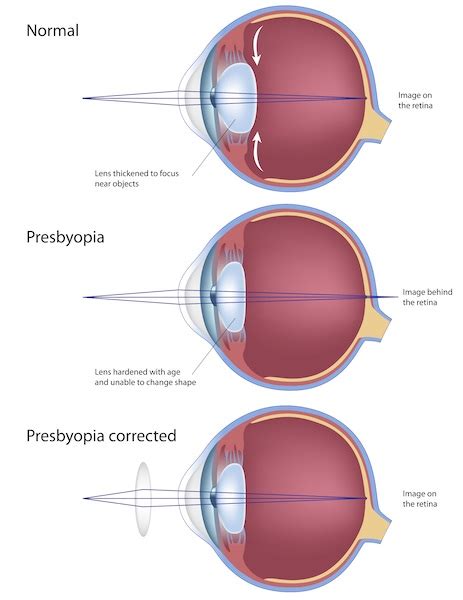 LASIK Livingston | LASIK Candidate | Associates in Ophthalmology