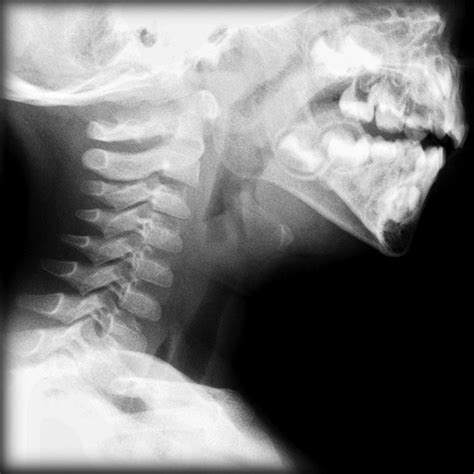 Pediatric Epiglottitis