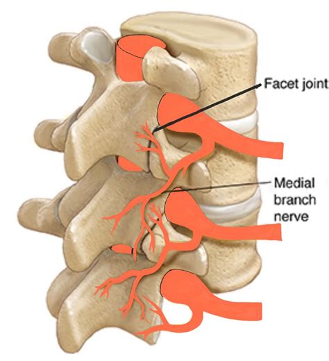 Facet Joint Denervation - Spines Dorset