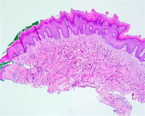 Proliferative Verrucous Leukoplakia Histology