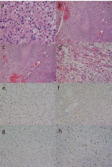 Photomicrographs showing histological findings of the tumor tissue in... | Download Scientific ...