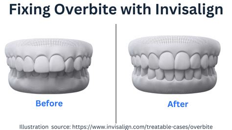 Can Invisalign Fix Overbite : How it Works and Timeline