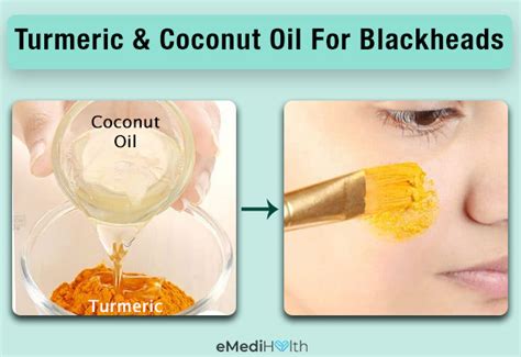 Home Remedies for Blackheads - Navtarang