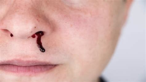 How To Stop Nose Bleed? - Aether Health - Kingwood ER