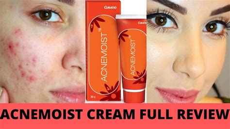 ACNEMOIST CREAM FULL REVIEW BEST CREAM FOR ACNE PRONE SKIN पिम्पल्स वाले लोगो के लिए बेस्ट क्रीम ...