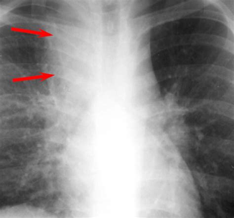 Tuberculosis Series: Physical Manifestations of TB Infection - EthnoMed