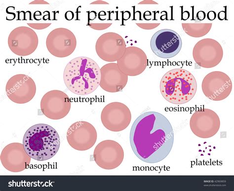 Anemia Peripheral Blood Smear