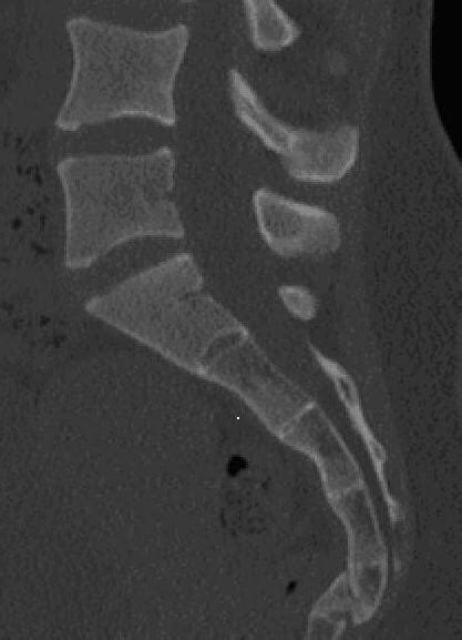 Broken Tailbone - Symptoms, Signs, Treatment, Recovery Time, Diagnosis