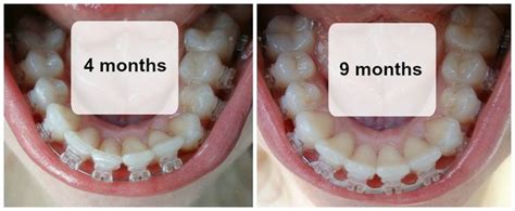 Pin on Radiance Plus Clear Sapphire Braces - Before and After