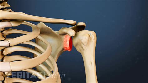 What is Shoulder Osteoarthritis (Glenohumeral Arthritis)? | Arthritis-Health