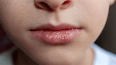 Dry Skin Around Your Mouth: Treatments & Home Remedies | Clinikally