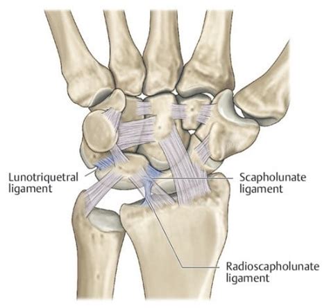 Ulnar-Sided Wrist Pain: Lunotriquetral Dissociation