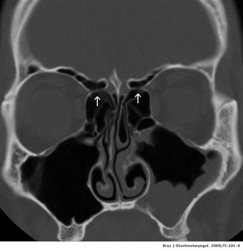 Anterior Ethmoidal Artery Evaluation on Coronal CT Scans | Brazilian Journal of ...