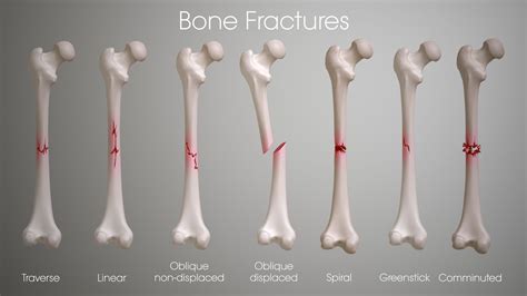 MEDICAL SCHOOL: Fracture types , Plaster Of Paris techniques and C... | Bone fracture, Fractures ...