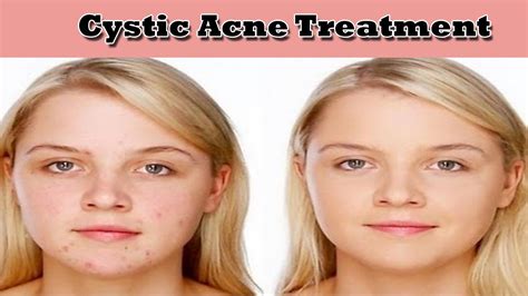 Cystic Acne Treatment/Cystic Acne Treatment Home Remedy- Stay Healthy - Number Source of Health ...