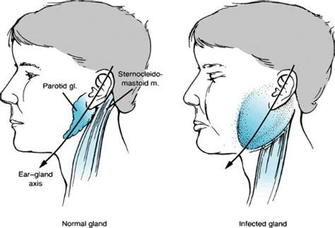 Parotid Gland Parotitis