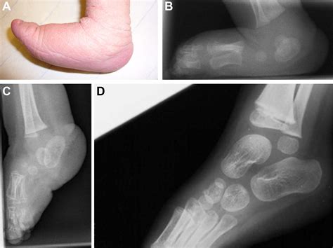 Congenital Vertical Talus - Foot and Ankle Clinics