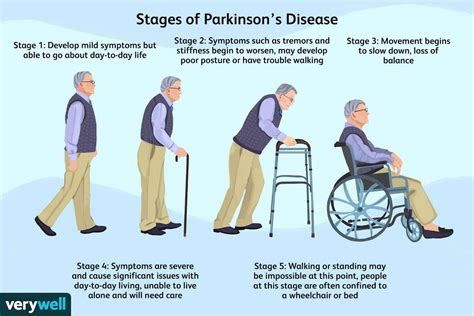 Stages of PD : r/youngparkinson