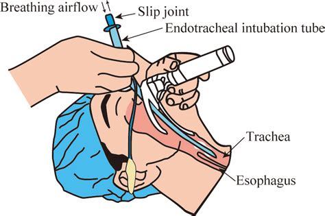 Esophageal Intubation