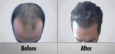 Hair Transplant Client Photo Gallery | Sure Hair Transplants Toronto, Ontario, Canada