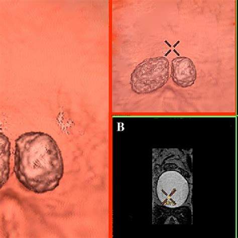 Different imaging modalities showing bilateral ureterocele. A... | Download Scientific Diagram