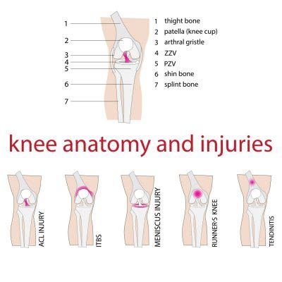 Knee Injuries