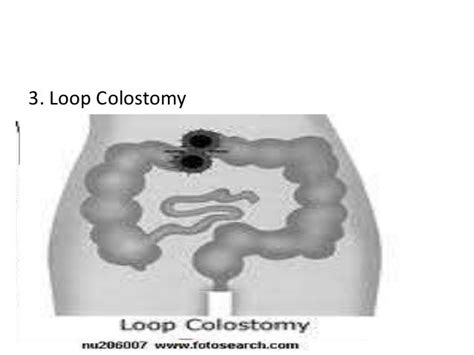 Colostomy