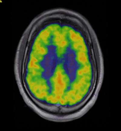 Neuroendocrine Tumors (NET) | Duke Department of Radiology