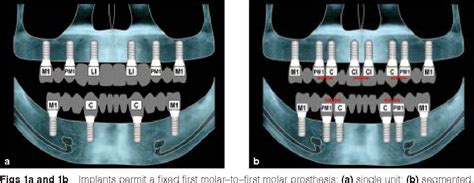 [PDF] Implant-prosthodontic classification of the edentulous jaw for ...