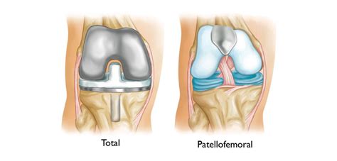 How to Predict Patellofemoral Arthroplasty Failures | Orthopedics This Week