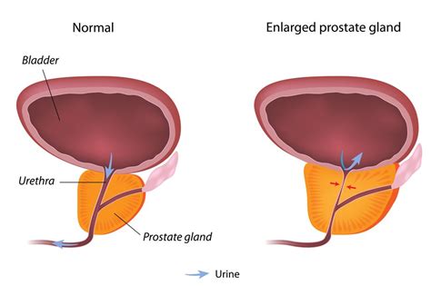 Diagram Of Bladder And Prostate