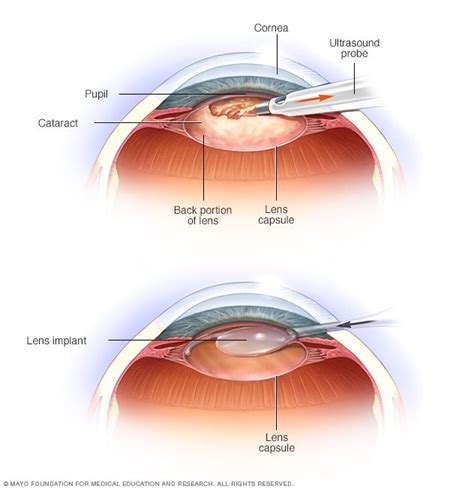 What Is Blended Vision In Cataract Surgery at Yvonne Morgan blog