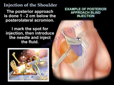 Injections Around The Shoulder - Everything You Need To Know - Dr. Nabil Ebraheim - YouTube