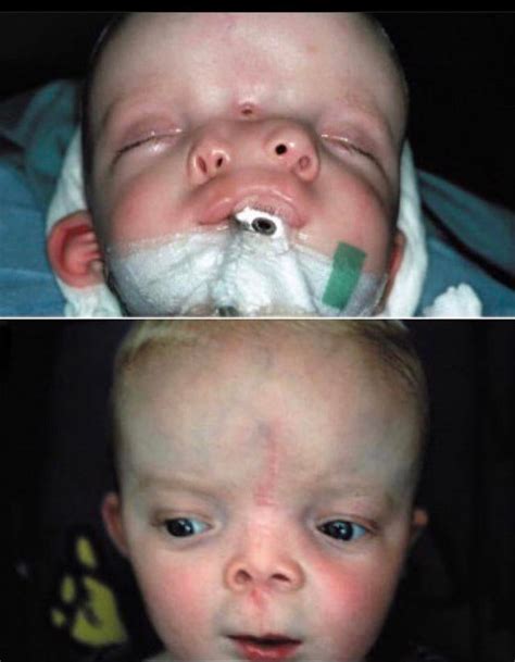 Little Girl with Hemangioma - Before & After Surgery Results : r/medizzy