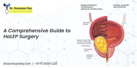 Everything You Need to Know About HoLEP Surgery!