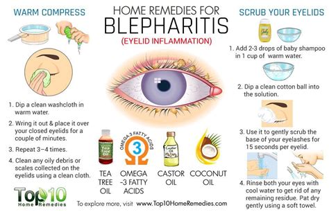 home remedies for blepharitis | Blepharitis, Remedies, Home remedies