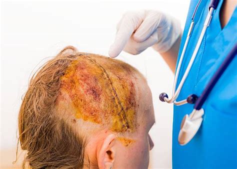 Craniotomy Stock Photos, Pictures & Royalty-Free Images - iStock