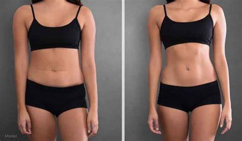 Abdominal liposuction pictures 3 - Liposuction before and after in 2020 | Liposuction recovery ...