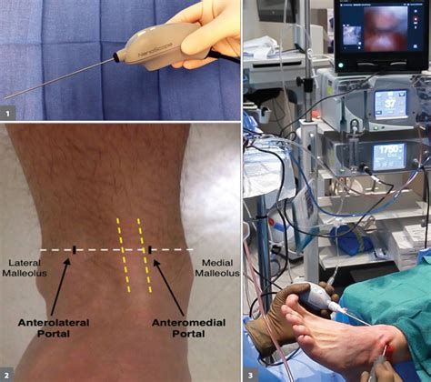 Various sports medicine conditions are amenable to ankle nano arthroscopy