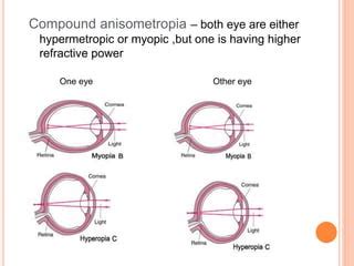 Anisometropia | PPT