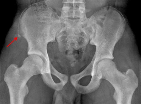 Pelvic Avulsion Fracture