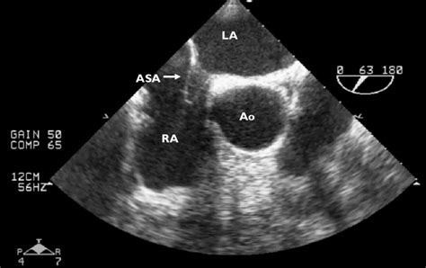 TEE image of ASA and PFO ASA, atrial septal aneurysm; LA, left atrium;... | Download Scientific ...