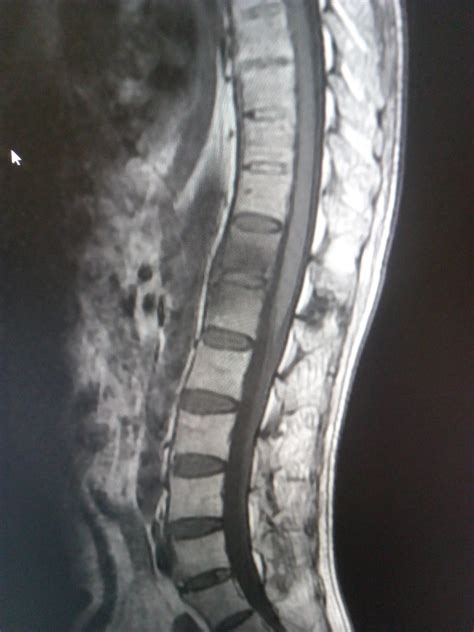 Ankylosing Spondylitis: MRI - Sumer's Radiology Blog