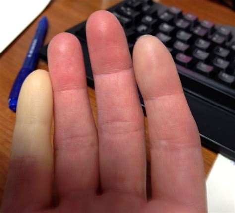 Raynaud's Phenomenon: The Mystery of the White Finger | At the Water's Edge