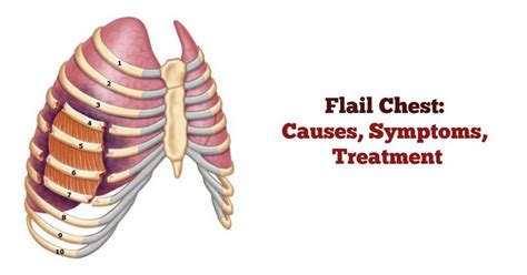 Flail Chest Diagram