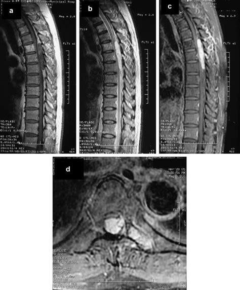 Infiltrating spinal angiolipoma - Journal of Clinical Neuroscience