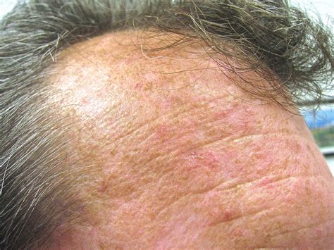 Actinic Keratosis Treatments | Plastic Surgery Skin Clinic